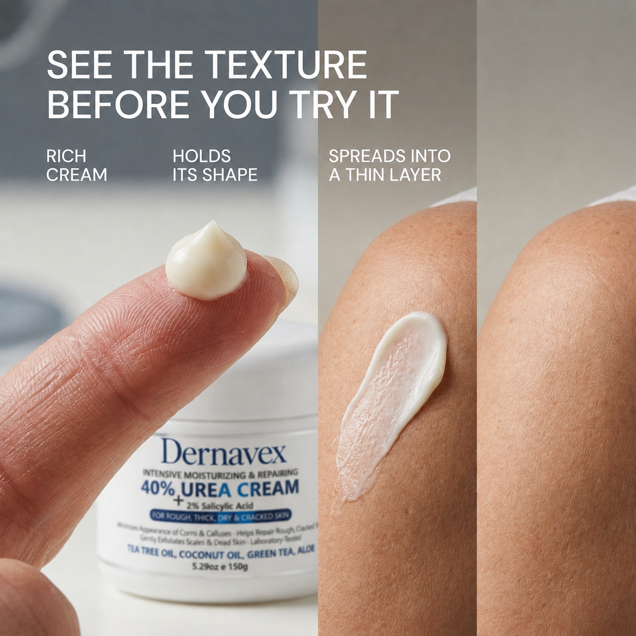 SK Renewal 40 - Advanced Keratolytic Cream For Rough, Raised Seborrheic Keratoses