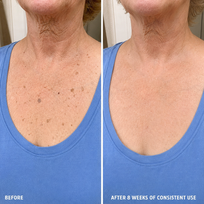 SK Renewal 40 - Advanced Keratolytic Cream For Rough, Raised Seborrheic Keratoses