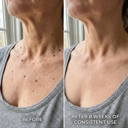 SK Renewal 40 - Advanced Keratolytic Cream For Rough, Raised Seborrheic Keratoses