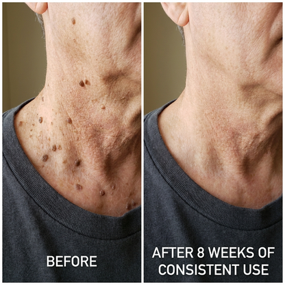 SK Renewal 40 - Advanced Keratolytic Cream For Rough, Raised Seborrheic Keratoses